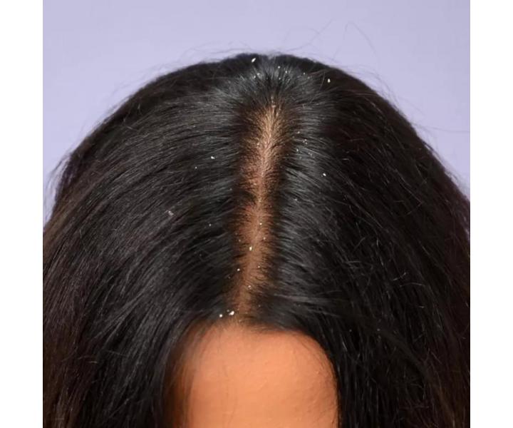 Przeciw�upie�owe serum koj�ce do sk�ry g�owy Schwarzkopf Professional BC Bonacure Anti-Dandruff Serum - 100 ml